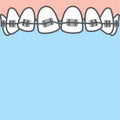 Blank banner Upper Braces teeth illustration vector on blue background. Dental concept