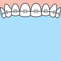 Blank banner Upper clear braces teetth illustration vector on blue background. Dental concept