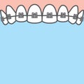Blank banner Upper metal braces upper teetth illustration vector on blue background. Dental concept Royalty Free Stock Photo