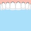 Blank banner Upper Essix retainer illustration vector on blue background. Dental concept Royalty Free Stock Photo