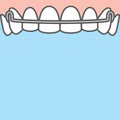 Blank banner Upper Hawley retainer illustration vector on blue background. Dental concept Royalty Free Stock Photo