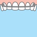 Blank banner Upper Hawley retainer illustration vector on blue background. Dental concept