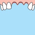 Blank banner Upper Lost teeth illustration vector on blue background. Dental concept Royalty Free Stock Photo