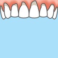 Blank banner Upper Periodontitis human gum inflammation illustration vector on blue background. Dental concept