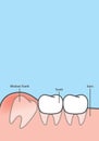 Blank banner wisdom Impacted tooth inside under inflammation gum illustration vector on blue background. Dental concept