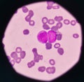 Blast cell on blood smear. Royalty Free Stock Photo