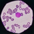 Blast cell on blood smear. Royalty Free Stock Photo