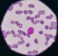 Blast cell on blood smear. Royalty Free Stock Photo