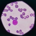 Blast cell on blood smear. Royalty Free Stock Photo