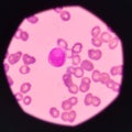 Blast cell on blood smear. Royalty Free Stock Photo