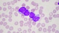 Blast cell in leukemia pateins in blood smear