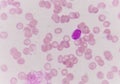 Blast cells in blood smear.