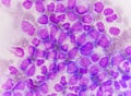 Blast cells in Leukemia