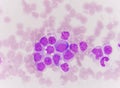 Blast cells in Leukemia