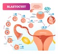 Blastocyst vector illustration infographic. Biological embryo early stage.