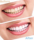 Bleaching teeth treatment Royalty Free Stock Photo