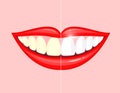 Bleaching teeth treatment. Royalty Free Stock Photo