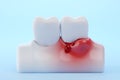 Bleeding gums and teeth blue background