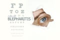 Blepharitis disease poster with eye test and blue eye on right