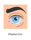 Blepharitis Human Eye Disease