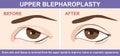 Blepharoplasty of eyelid , before and after. Vector illustration with double eyelid surgery. Infographics with icons of