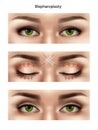 Blepharoplasty Suture Stitches Composition