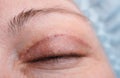 Blepharoplasty of the upper eyelid. Royalty Free Stock Photo