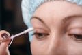 Blepharoplasty of the upper eyelid. Royalty Free Stock Photo