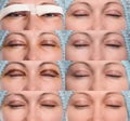 Blepharoplasty of the upper eyelid. Royalty Free Stock Photo