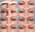 Blepharoplasty of the upper eyelid.