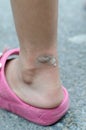 Blister on ankle Royalty Free Stock Photo