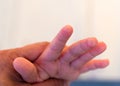 the blister on children finger caused by hot water injury Royalty Free Stock Photo