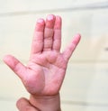 The blister on children finger caused by hot water injury Royalty Free Stock Photo