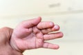 the blister on children finger caused by hot water injury Royalty Free Stock Photo