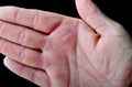 Blister on hand caused by a burn. Royalty Free Stock Photo