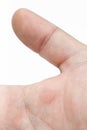 Blister on palm Royalty Free Stock Photo