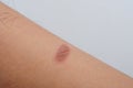 Blister was caused by a burn or scald, sunburn, or an allergic reaction Royalty Free Stock Photo