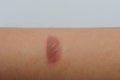 Blister was caused by a burn or scald, sunburn, or an allergic reaction Royalty Free Stock Photo