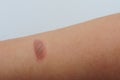 Blister was caused by a burn or scald, sunburn, or an allergic reaction Royalty Free Stock Photo