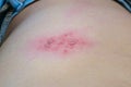 Blisters caused by shingles on skin, herpes zoster