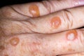 Blisters from cryotherapy treatment for solar keratosis