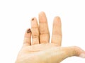 Blisters on finger caused Royalty Free Stock Photo
