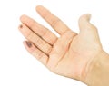 Blisters on finger caused Royalty Free Stock Photo