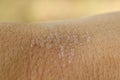 Blisters on human skin on the hand from sunburn close-up. Royalty Free Stock Photo