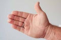 Blisters on two fingers of a man's hand Royalty Free Stock Photo