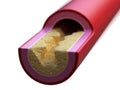 A blocked artery Royalty Free Stock Photo