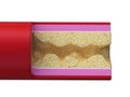A blocked artery Royalty Free Stock Photo