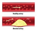 Blocked artery, fat stuck in the blood artery, cholesterol Royalty Free Stock Photo