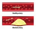 Blocked artery, fat stuck in the blood artery,