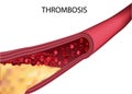 Blocked blood vessel - artery with cholesterol buildup realistic vector illustration isolated background